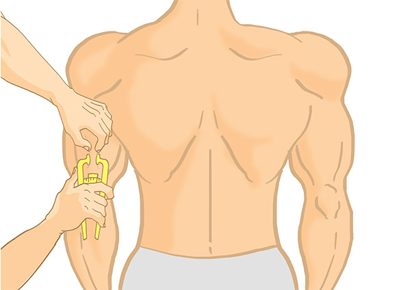 Kallipermåling triceps